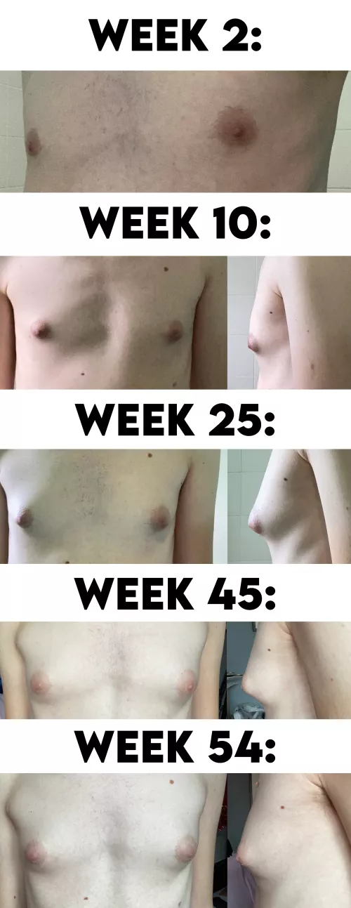 1 Year Anniversary Update! 27, 0.4ml/31 Days DIY Estradiol Undecylate. What Tanner Stage Am I Now At?