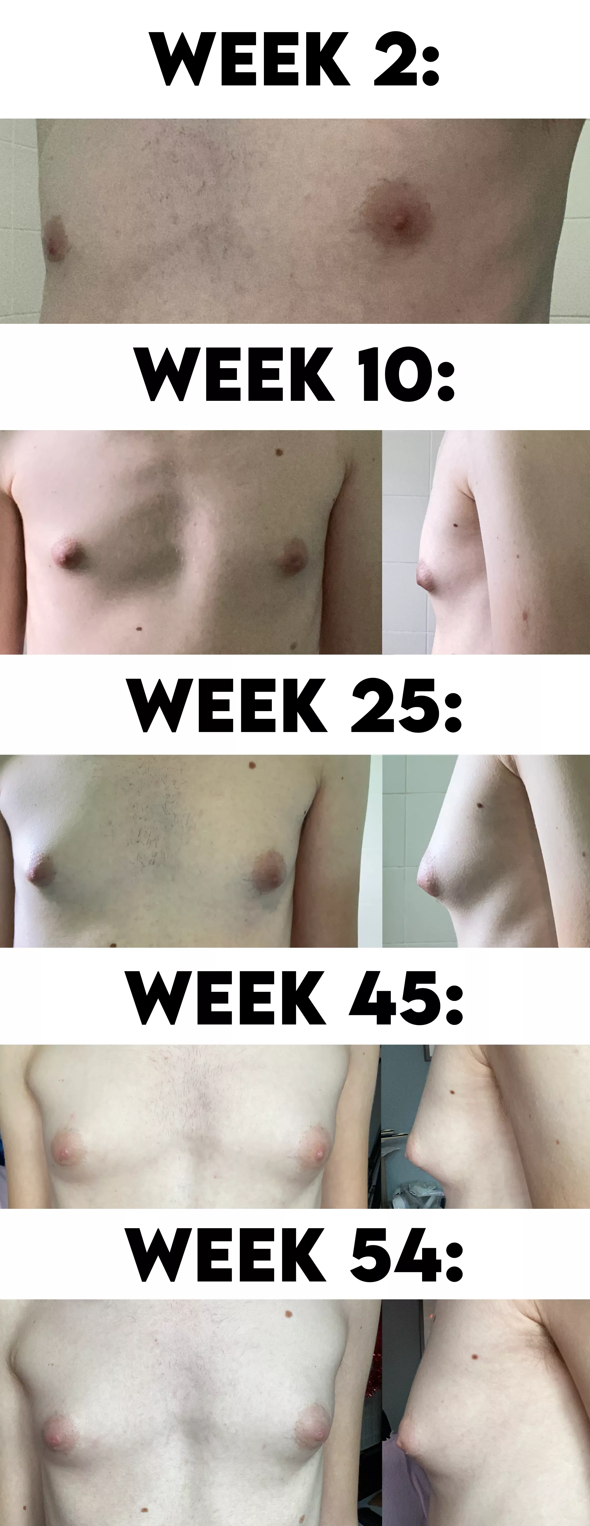 1 Year Anniversary Update! 27, 0.4ml/31 Days DIY Estradiol Undecylate. What Tanner Stage Am I Now At?