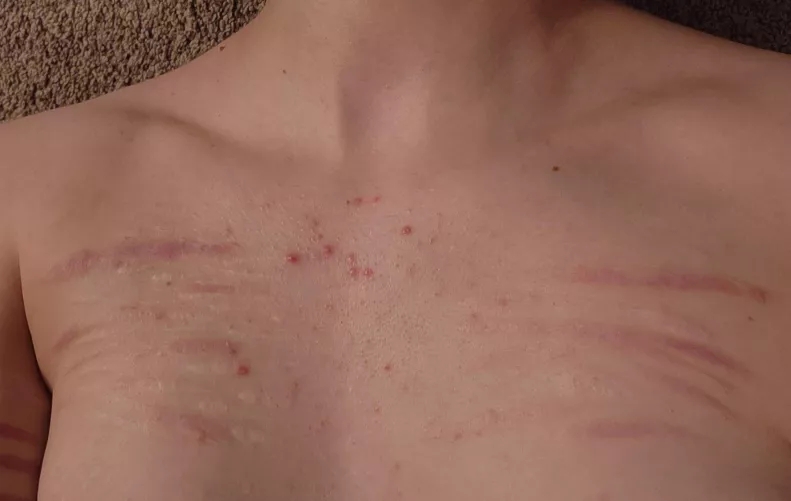 are my chest scars gross?