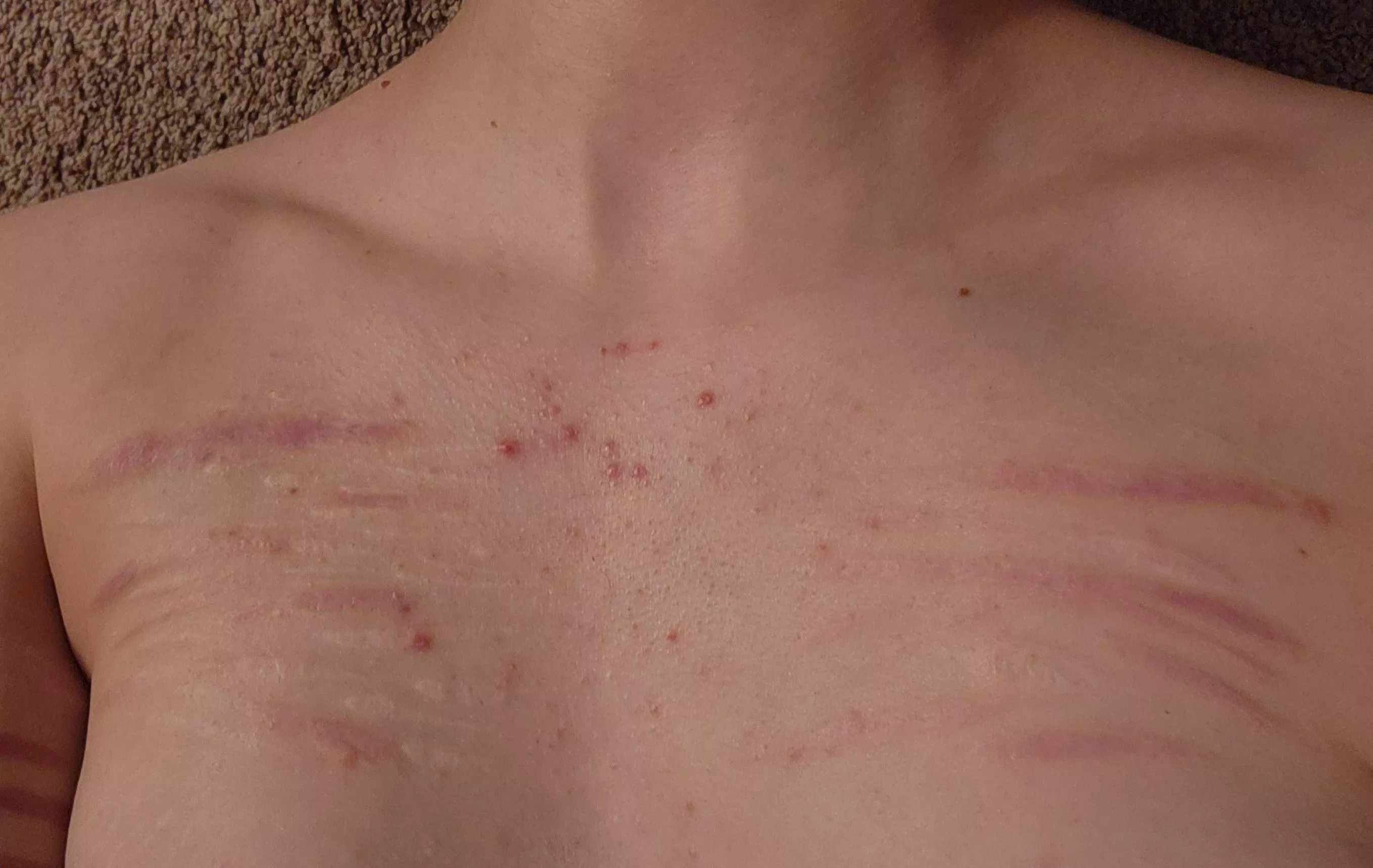 are my chest scars gross?