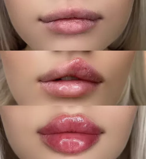 Bolted on lips in progress