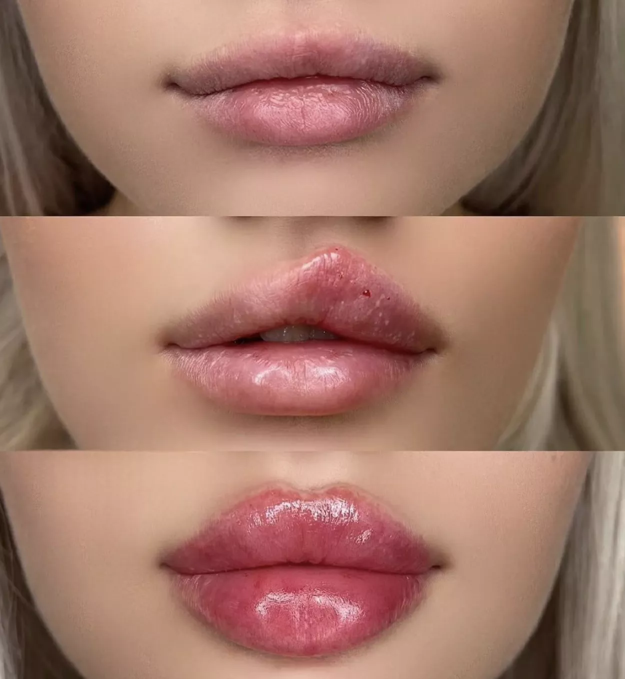 Bolted on lips in progress