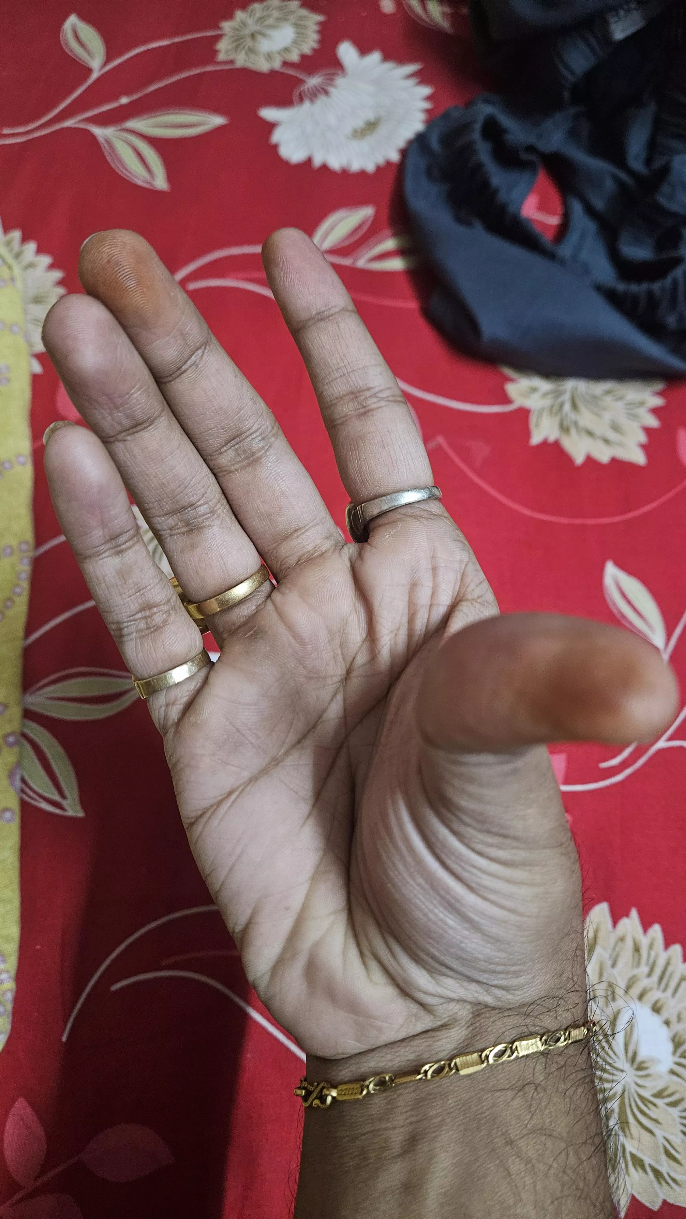 Can anyone tell me what are these orange mark, having a carrot, beet apple juice in the morning daily for the last one and a half week, not painful. I do have genetic heart disease, but  not that serious, please enlight me someone