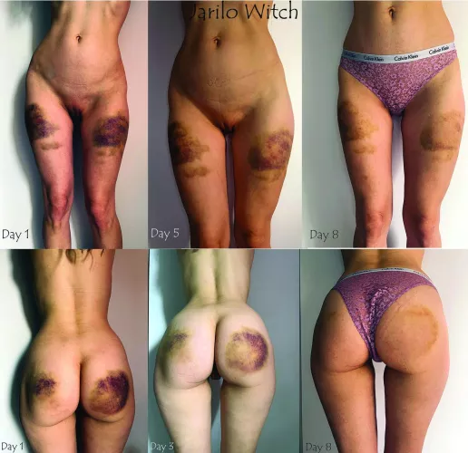 Do you like to see the effects of your spanking fading away slowly as the days pass by?