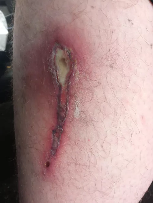 Got cooked by my heating blanket. Think I'll loose my leg?