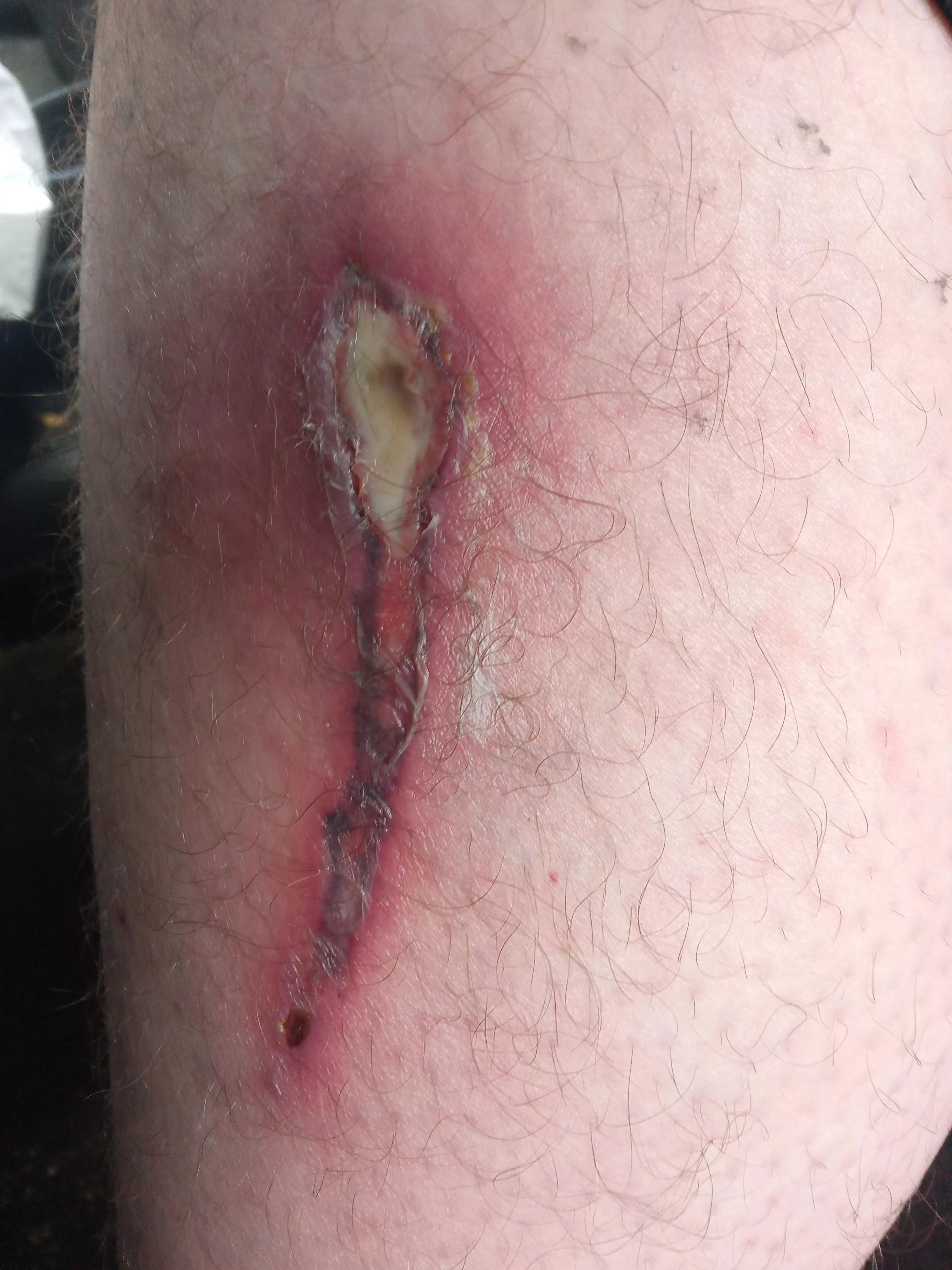 Got cooked by my heating blanket. Think I'll loose my leg?