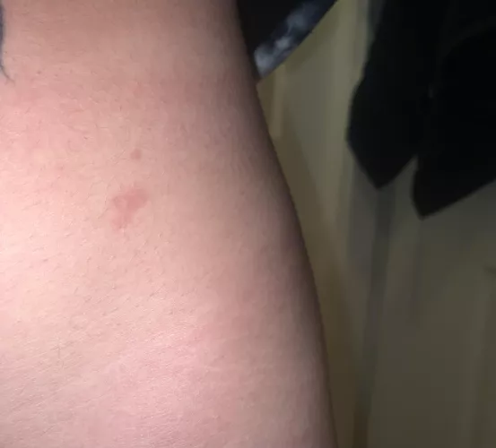 Irritation to clothing? 