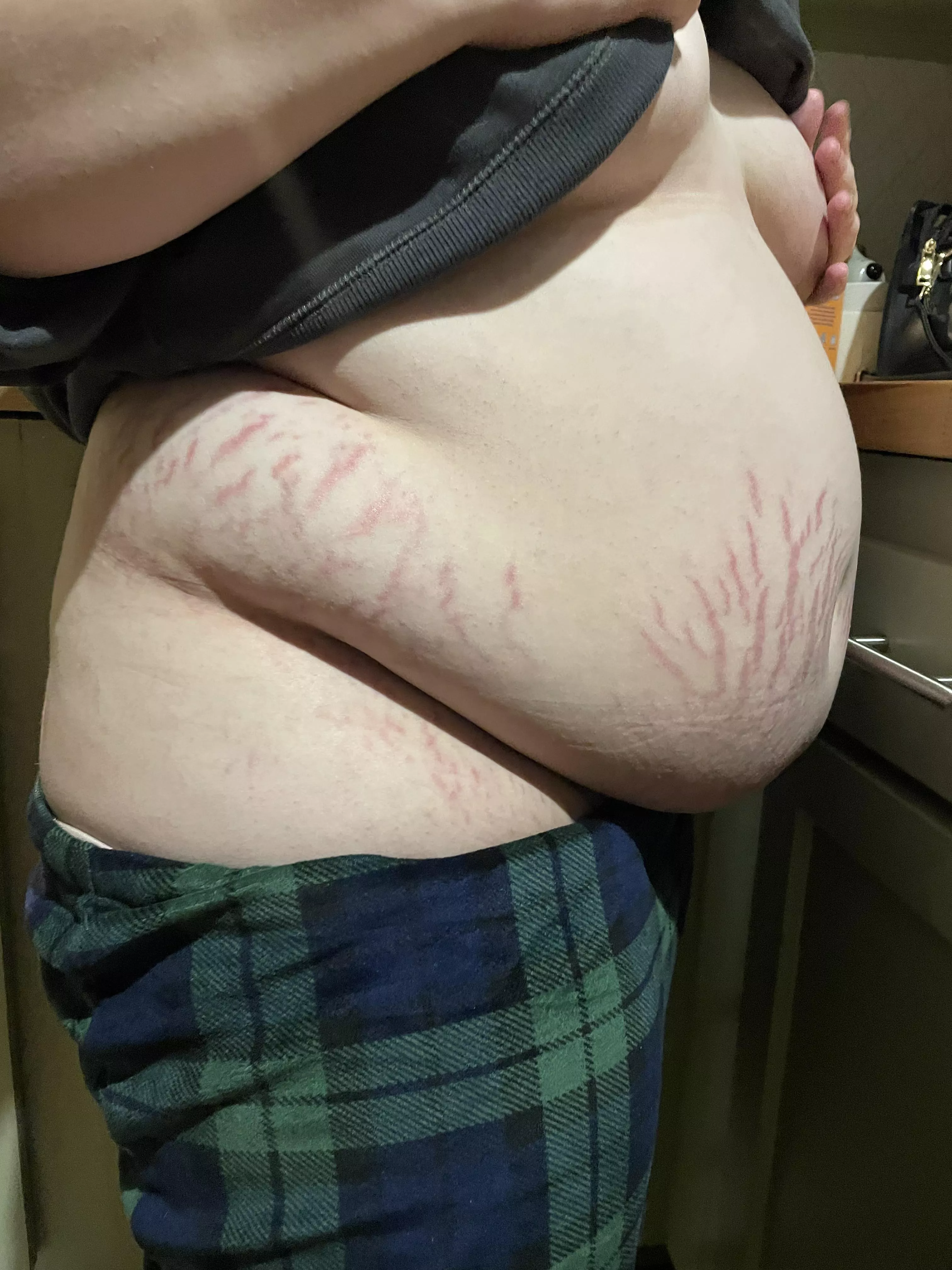 these stretch marks r out of control 🐷
