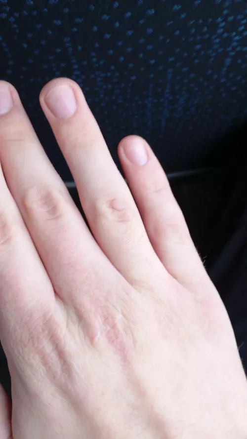 What's this thing on my ring finger that I had my entire life