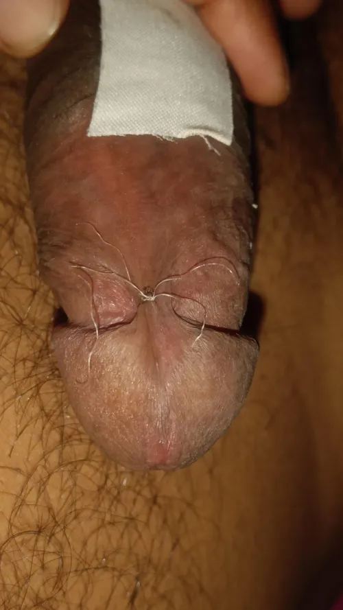 Frenulum tying - Day 3