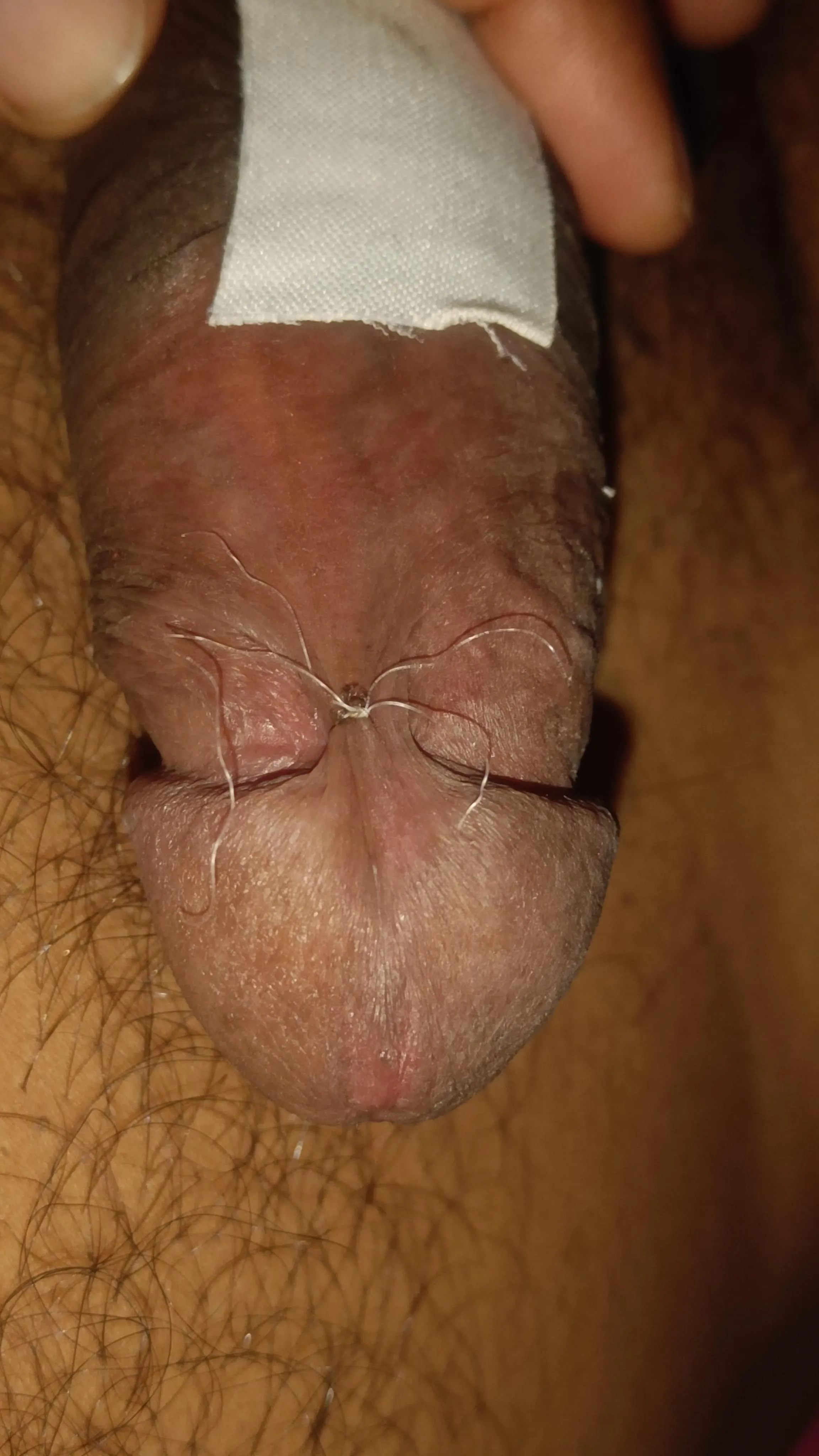 Frenulum tying - Day 3