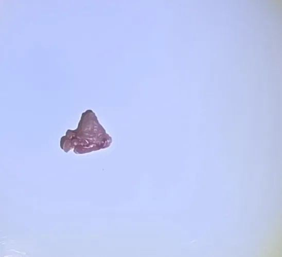 Removed part of fren