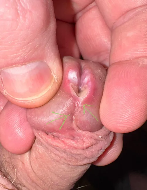 What line should I follow on my next cut for meatotomy?   You can see from photo I went a little off center on first cut with the cautery pen.   I want to do the full glans but want it to look nice.  Follow the line there?