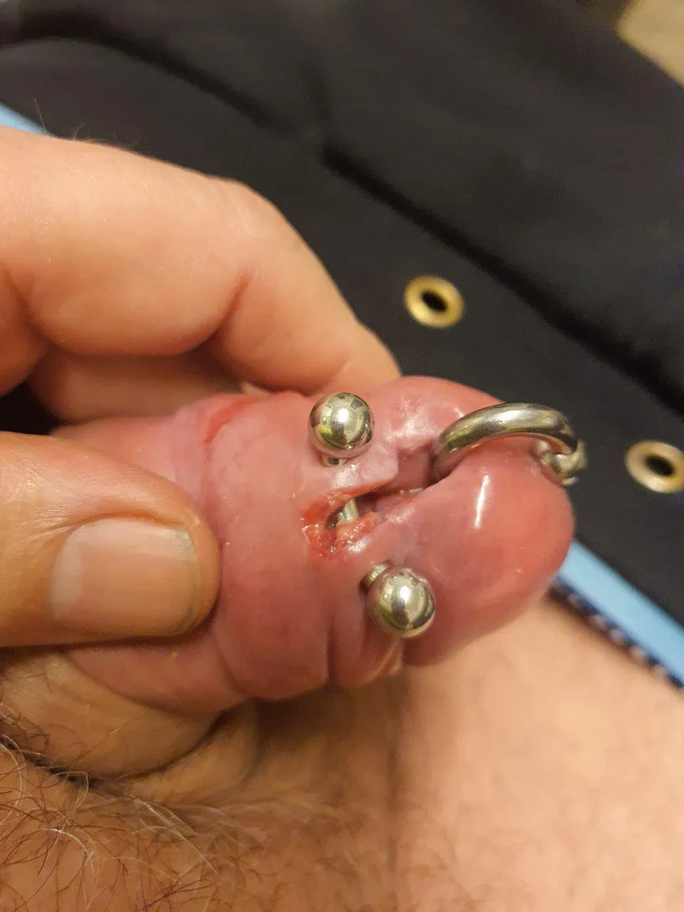 Cut through the frenulem