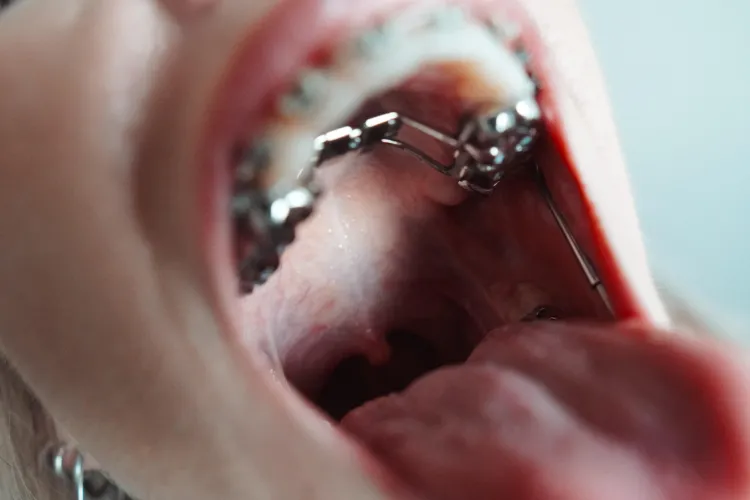 Kinky braces girl, at your service 🫡