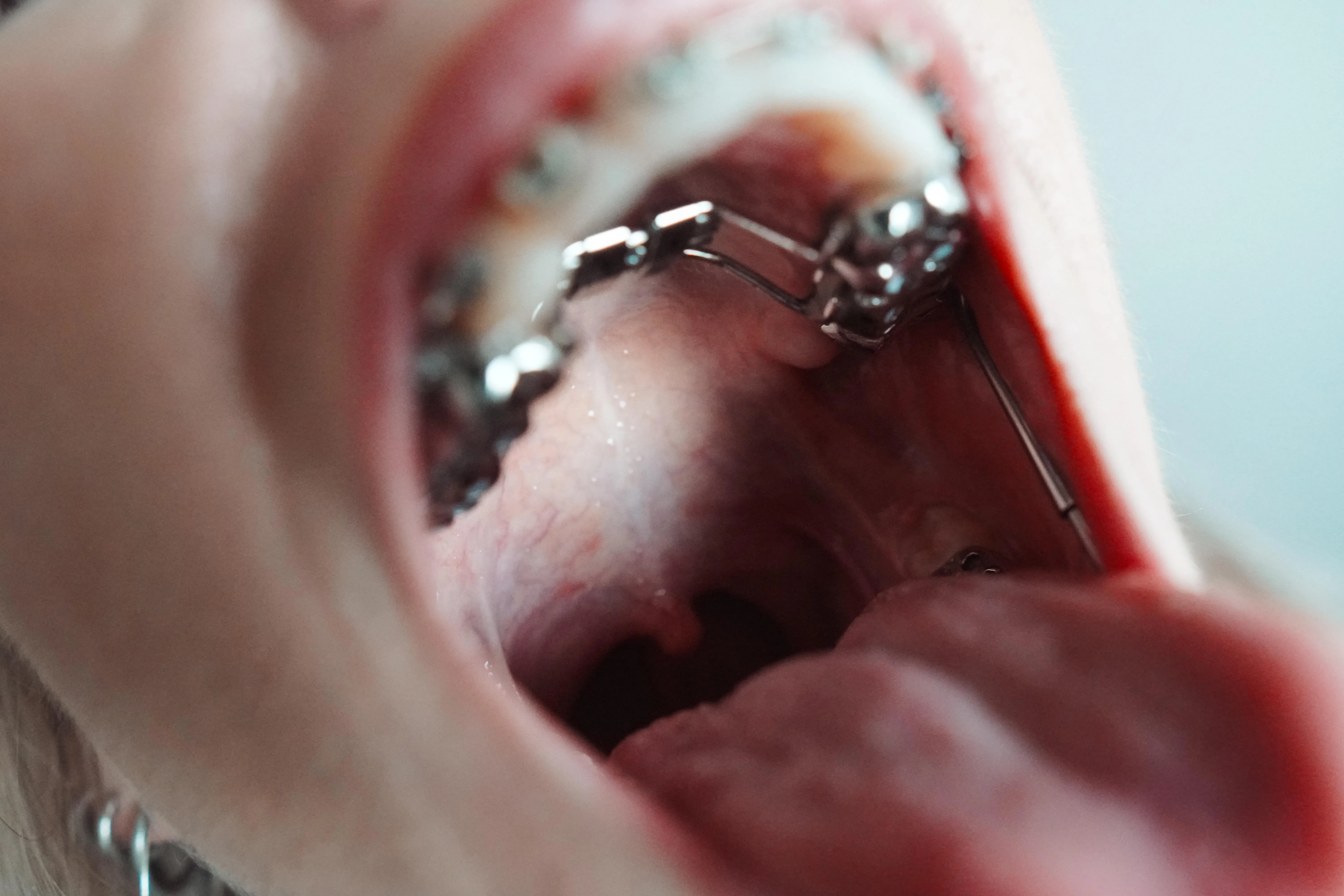 Kinky braces girl, at your service 🫡