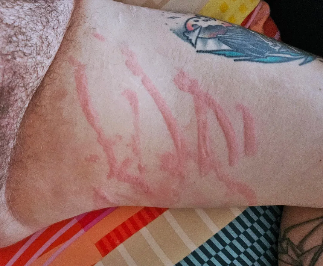 Elastic bands make quite the welts