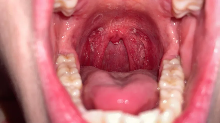 Blemishes/skin peeling in the roof of my mouth. Anyone hve any ideas What this is?