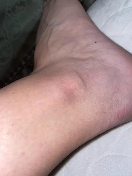 Could this be a blood clot? I had a little injury 2 hours ago and this is what my ankle looks like.