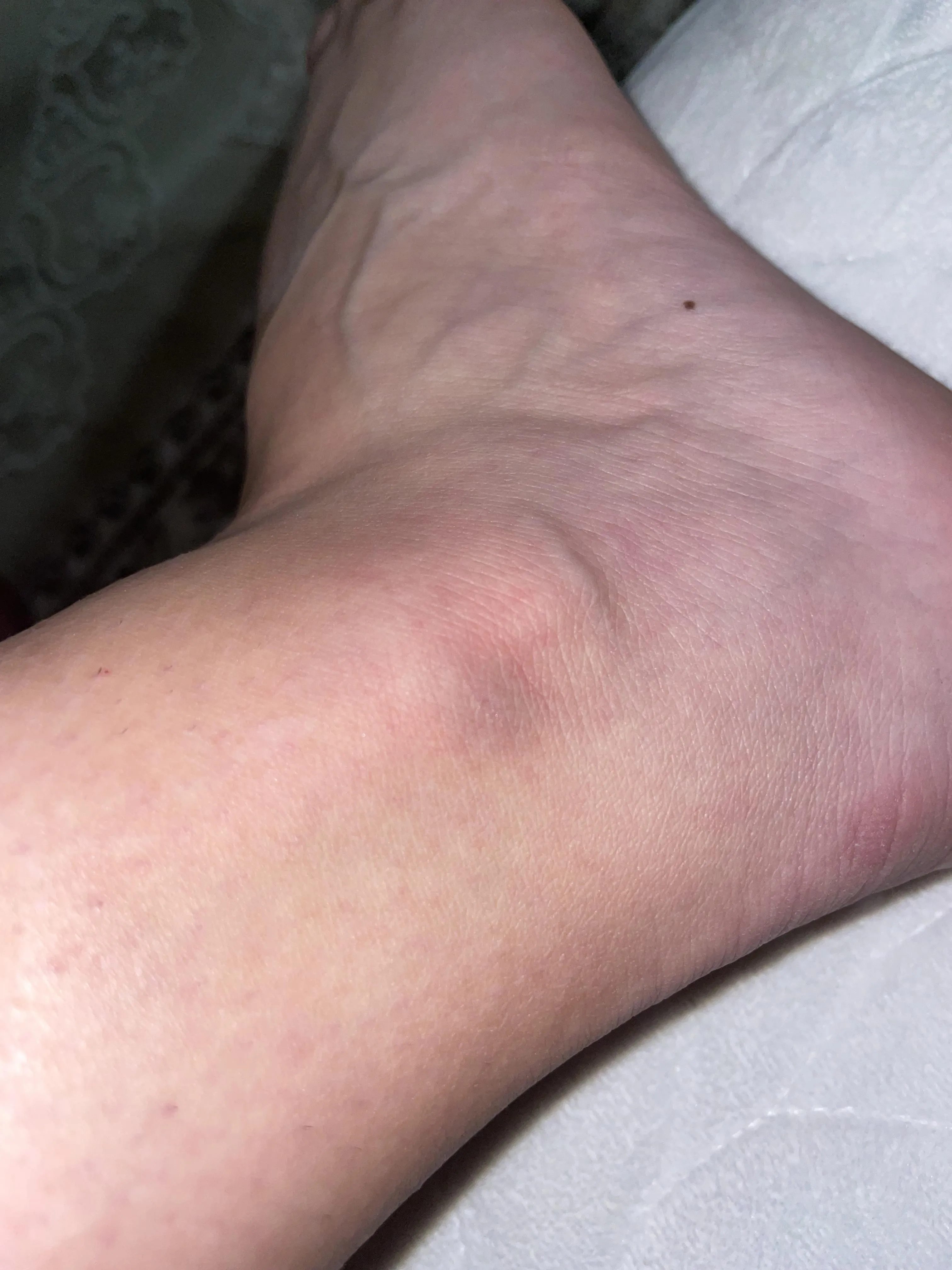 Could this be a blood clot? I had a little injury 2 hours ago and this is what my ankle looks like.