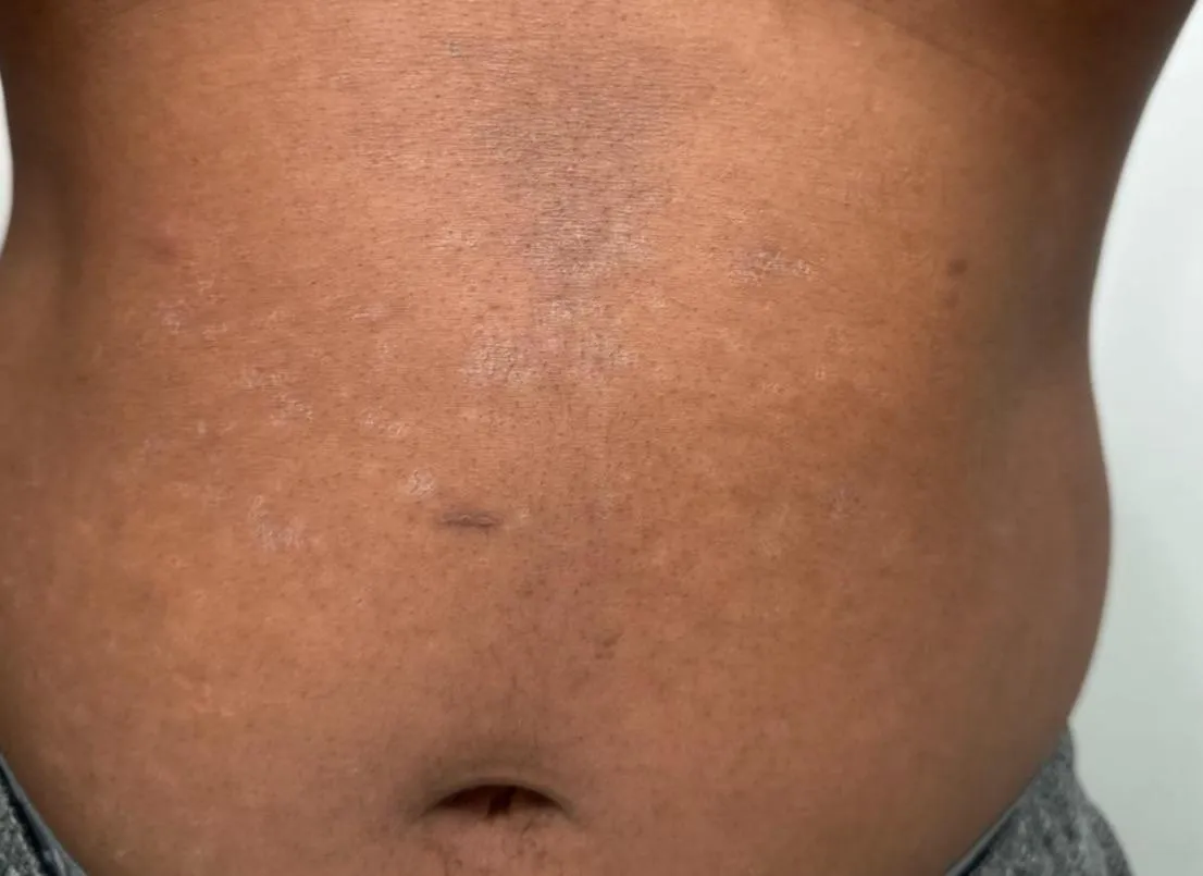 Hey, I’m curious to see if these stretch marks are normal, I’ve never been this big ever