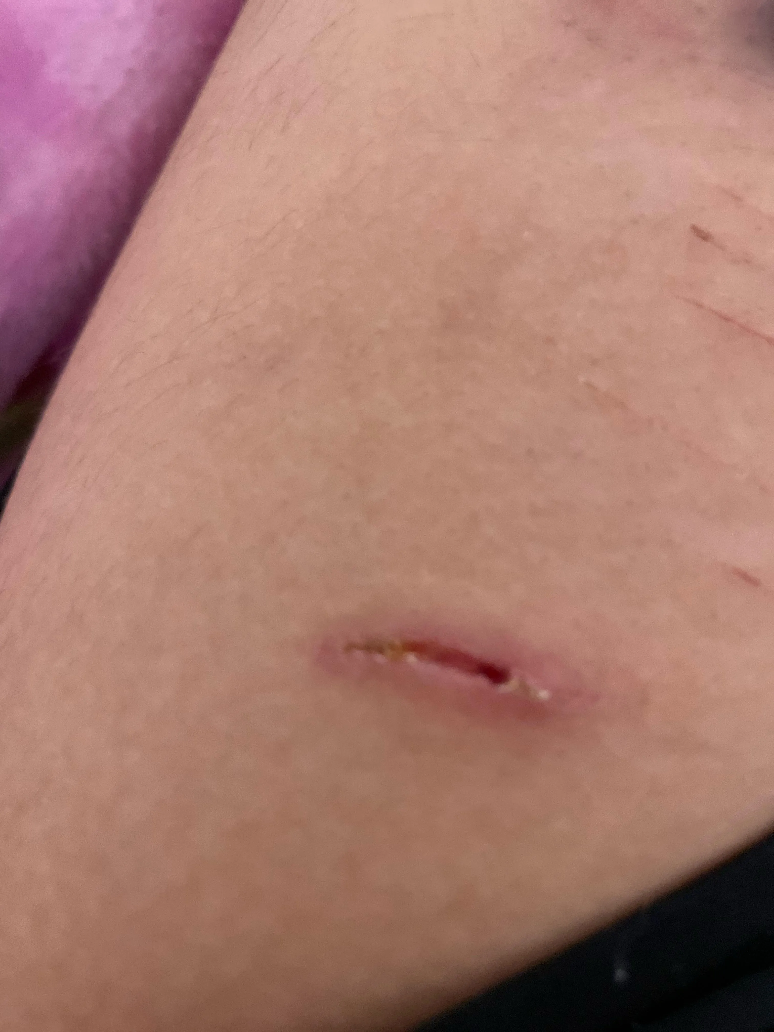 how deep??? will it scar????  (trigger warning for self harm!) please don’t click if you will get triggered!