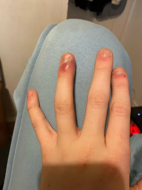Not urgent. 3 Days since noticing potential septic finger, what should i do?