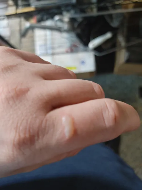 What is this? Looks like a burn but I haven't burned myself. I have no idea where it came from.