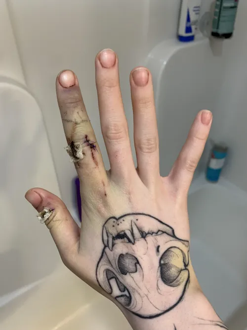 7 stitches and a severed vessel