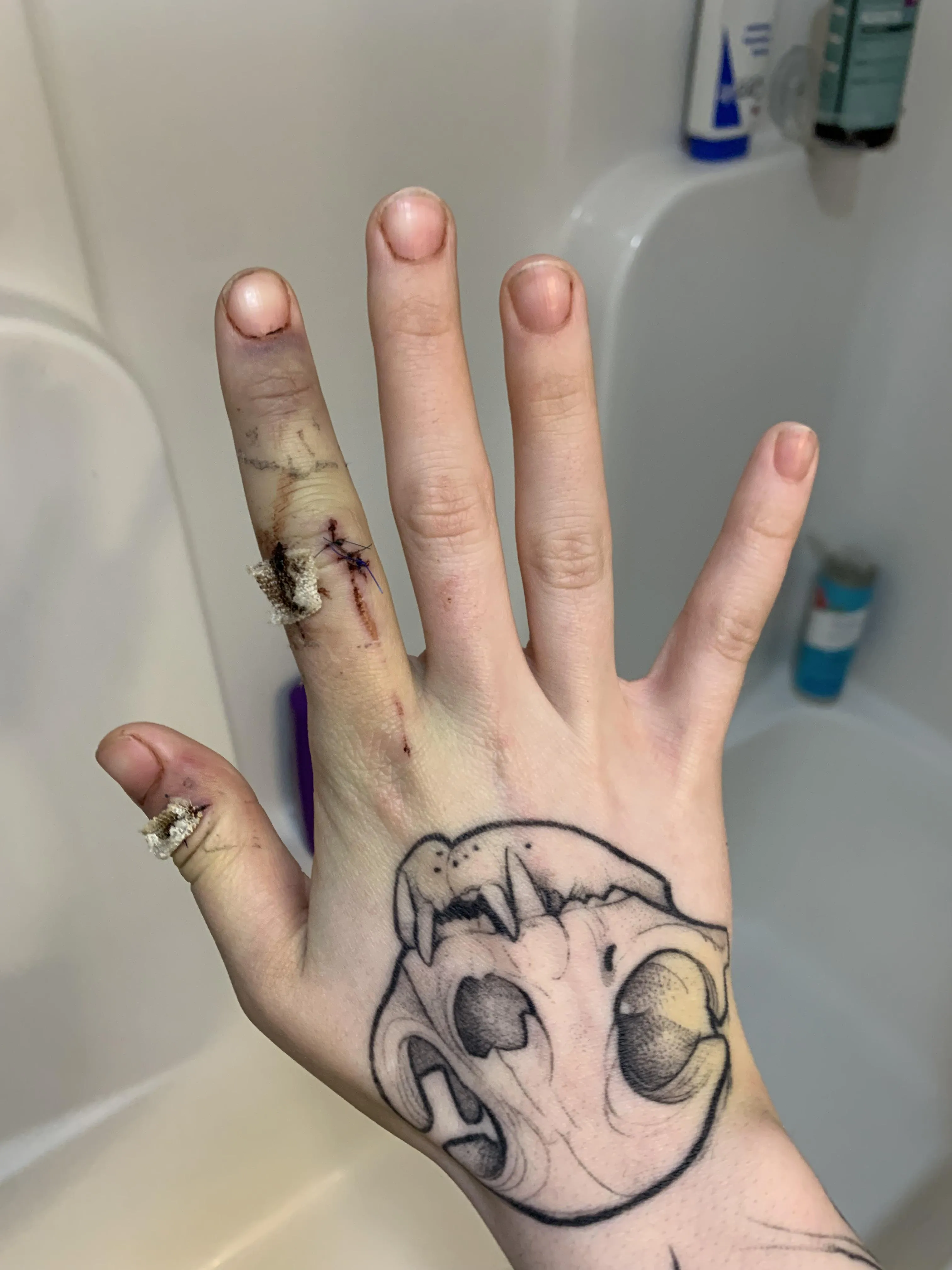 7 stitches and a severed vessel