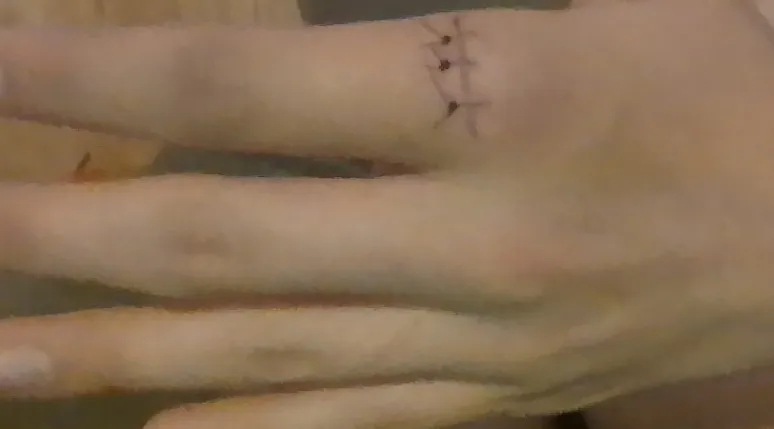 Accidentally sliced my knuckle doing yard work(I don't have any before-stitch pictures)