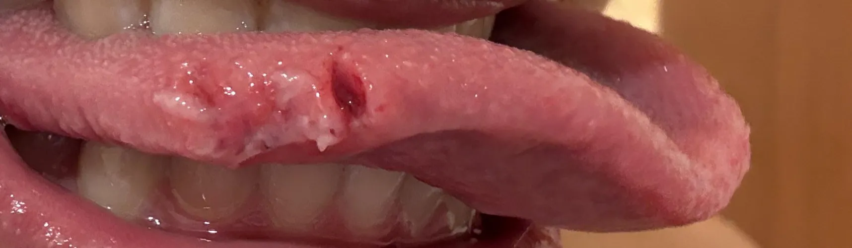 bit my tongue accidentally because of an upwards headbutt  to jawbone from a guy while playing basketball