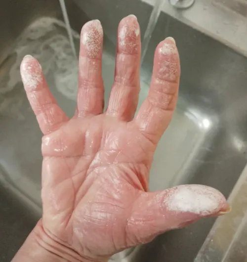 Chemical burn after someone put too much chemical in a spray bottle