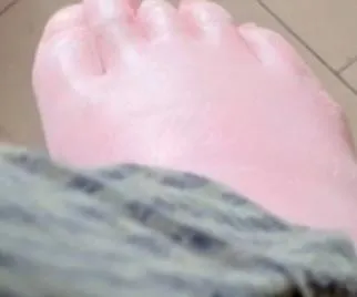 Soft paralyzed feet. C5 SCI