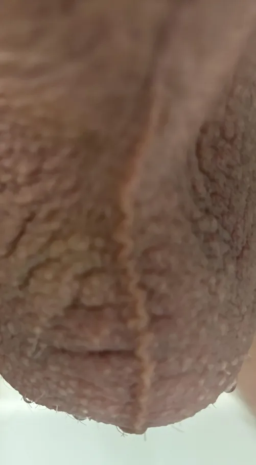I think my scrotal raphe is lightly damaged