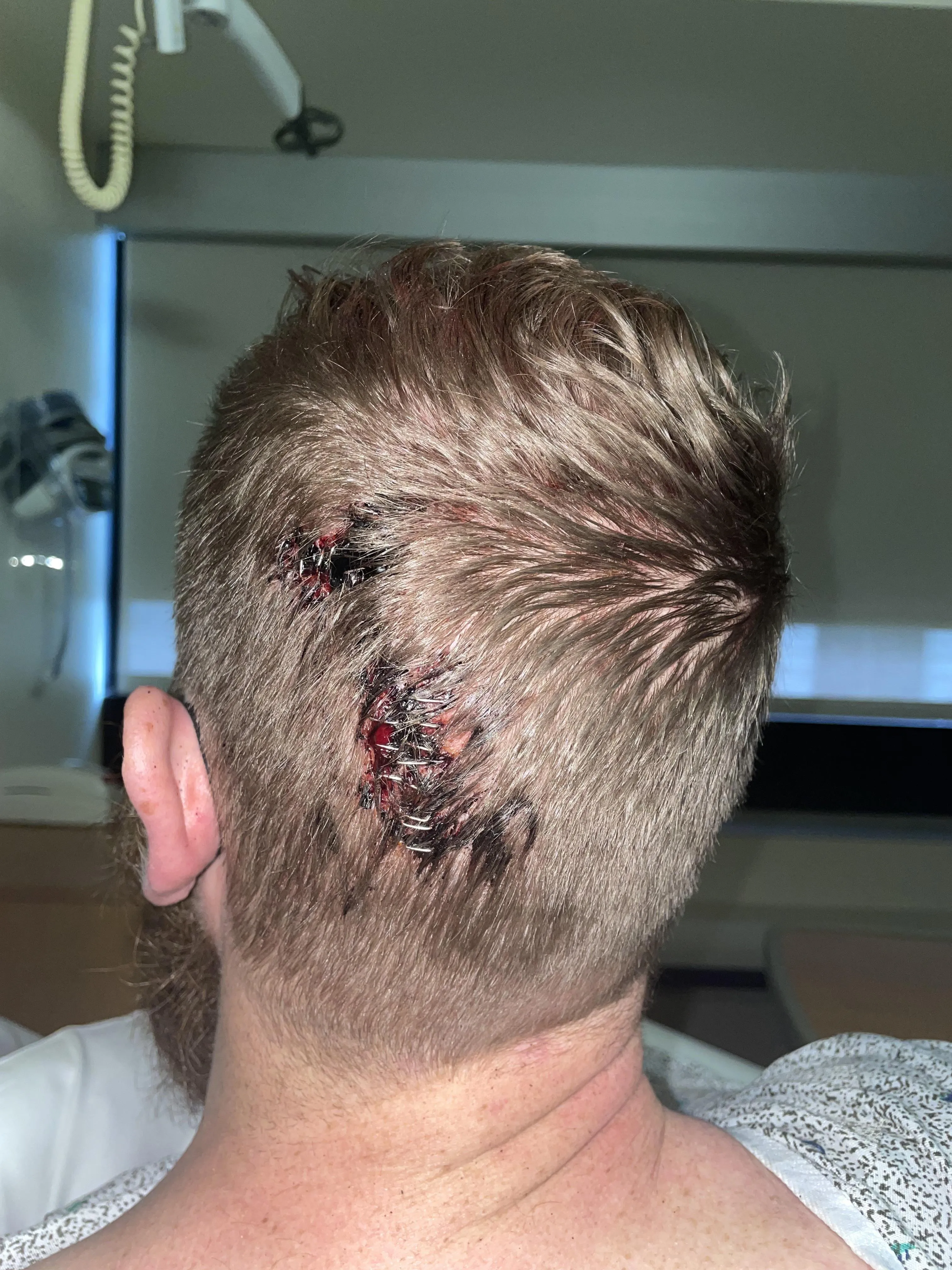 13 staples after drunken fall.