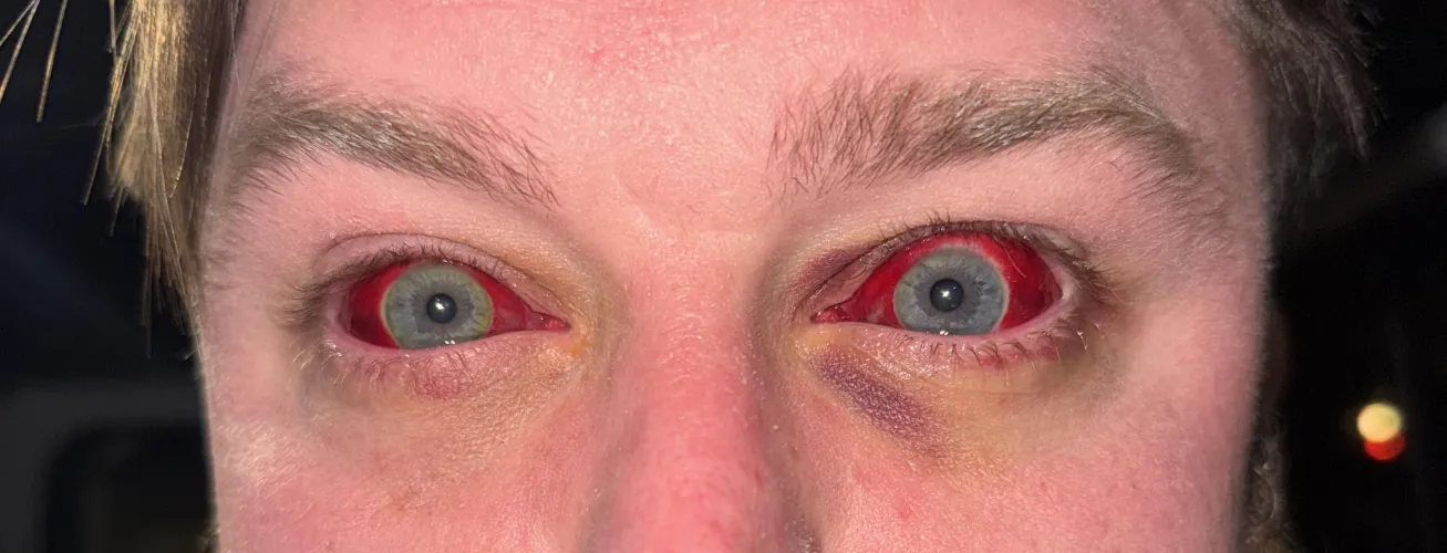 A lil ocular hemorrhage for your viewing