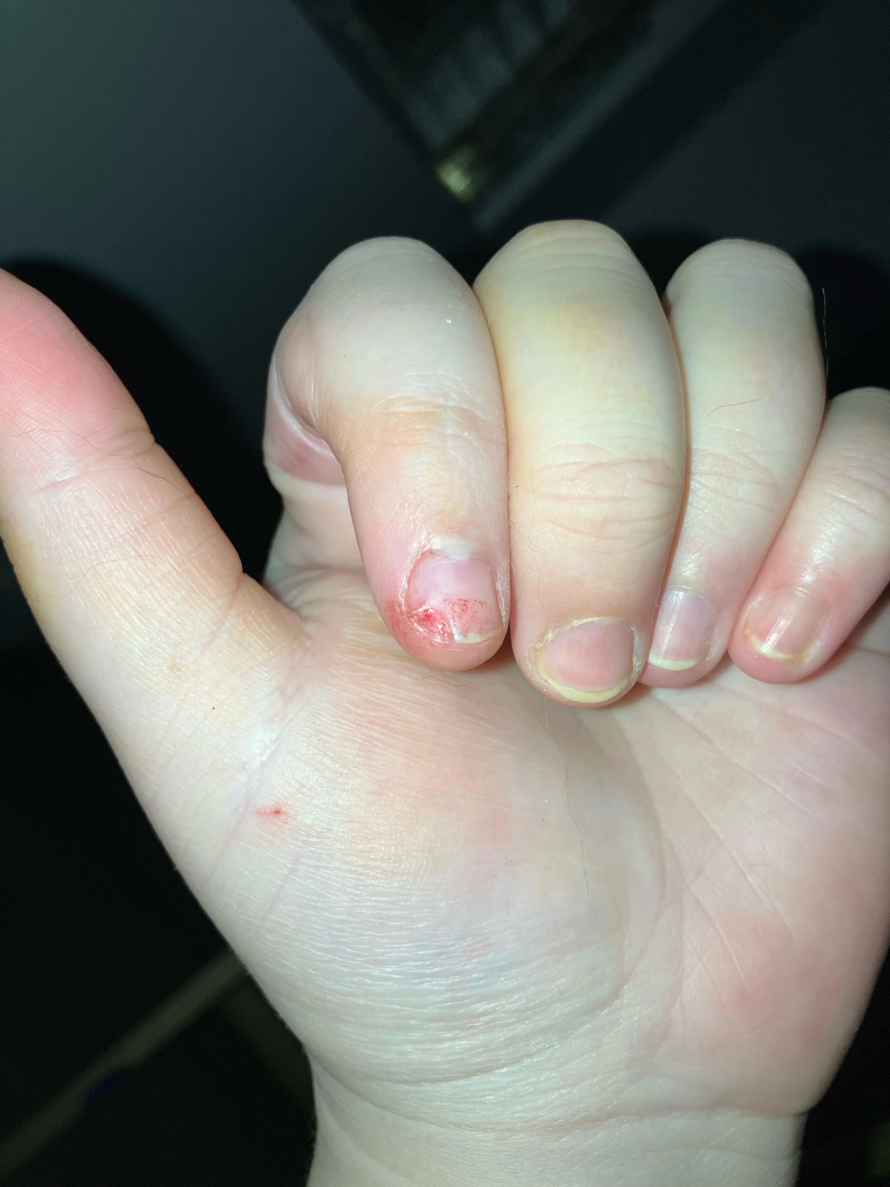 Cut part of my nail off