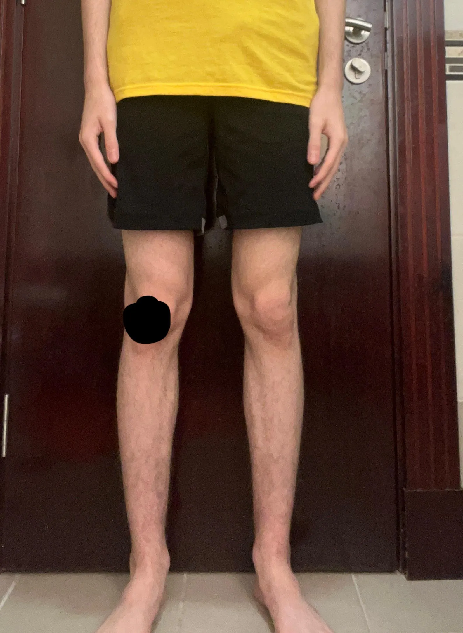 Rate my Legs, my knee is fucking bleeding that’s why there is a black marker cover.