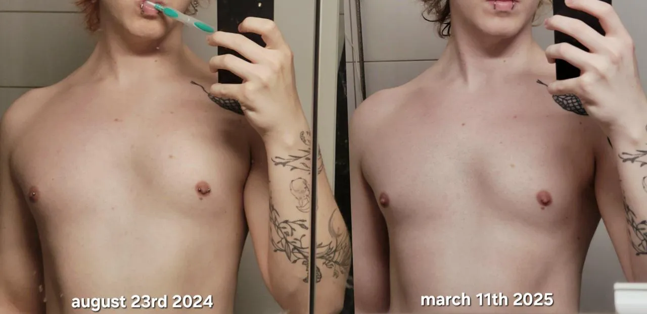 8 months HRT (non-binary)