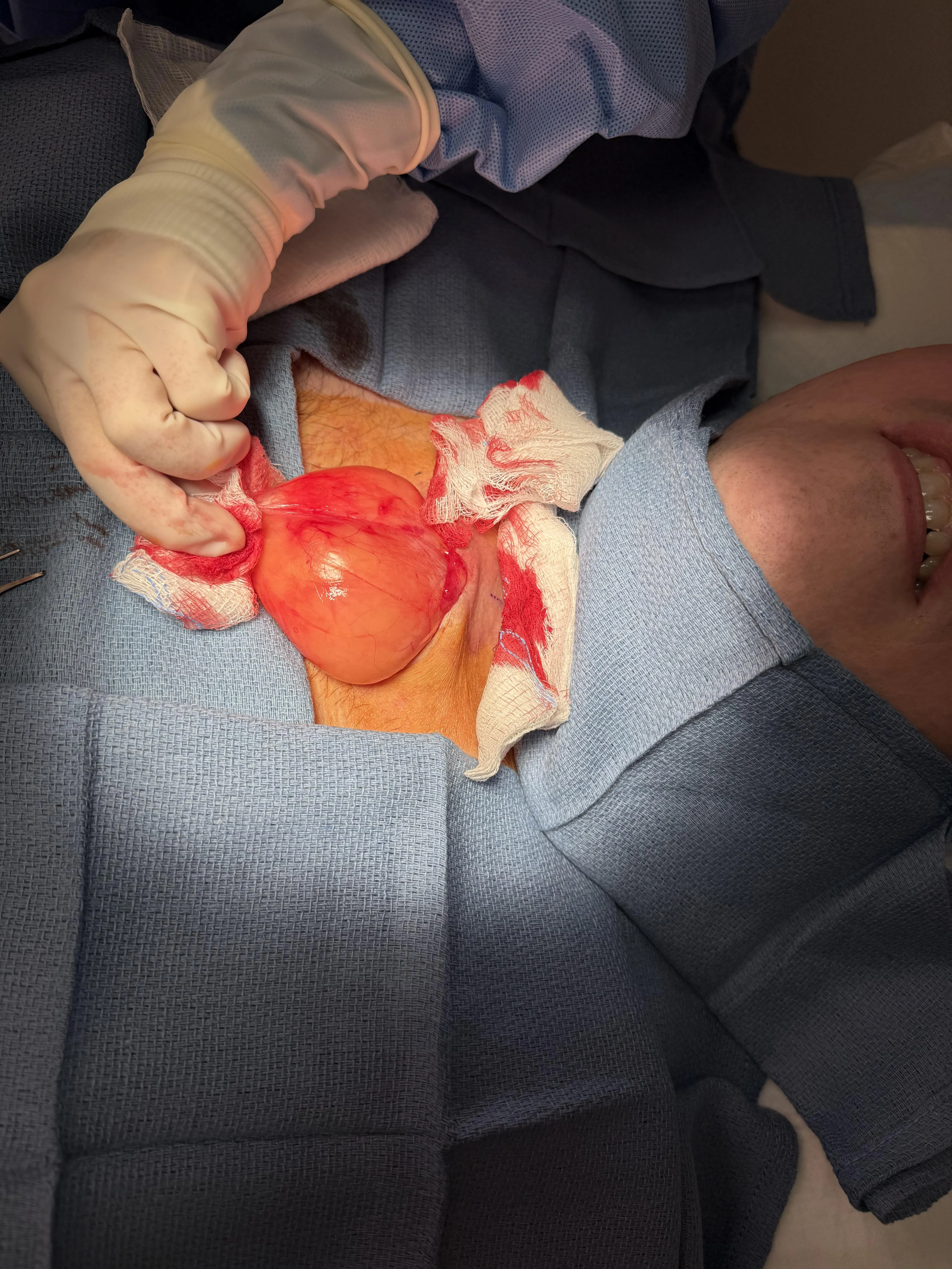 Had a massive Lymphoma removed from my neck while awake.