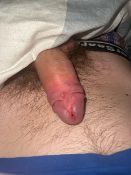 I just cut my frenulum and Im so happy I finally cut it