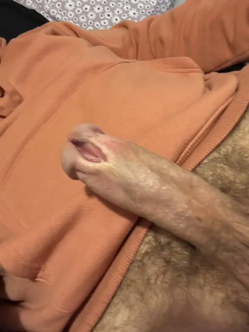 Never took pics of progress. Healed after 2nd cut