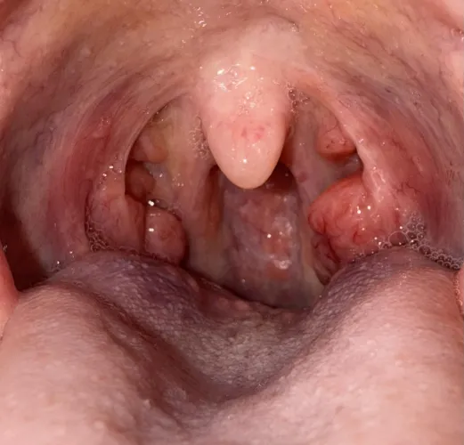 Any advice on how to handle reoccurring tonsillitis until I see ENT?