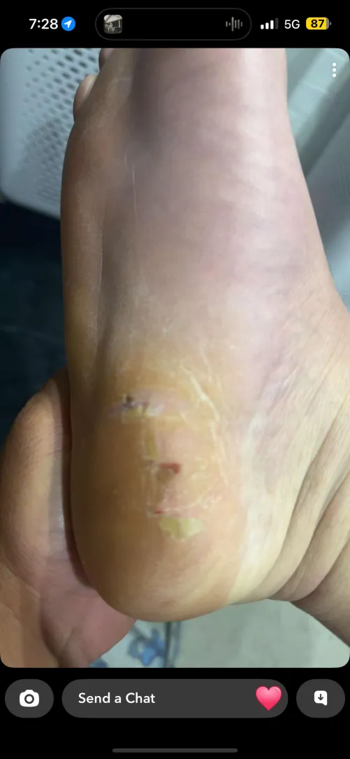 Anyone know what this is. I work in construction and am normally in steel cap boots for long hours. I got this randomly but it’s not causing pain and I can walk on it.