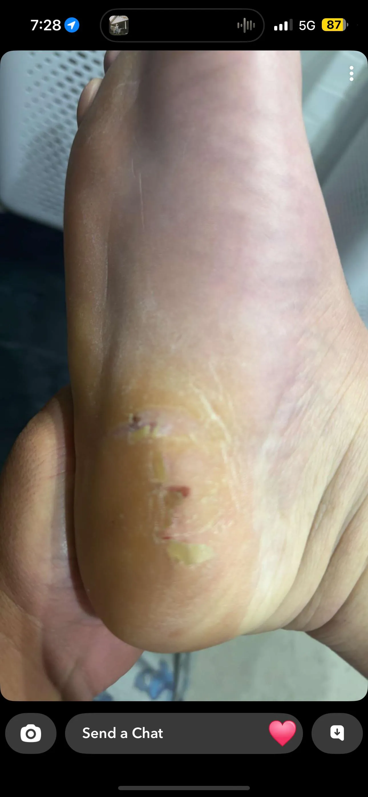 Anyone know what this is. I work in construction and am normally in steel cap boots for long hours. I got this randomly but it’s not causing pain and I can walk on it.