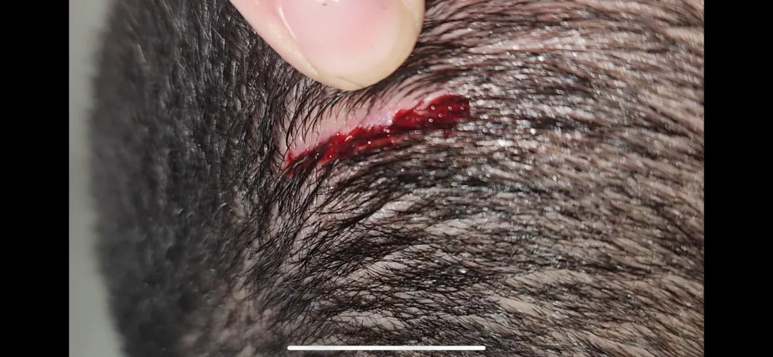 Cut my head on a corner of a flat piece of metal. Do I leave work to go get stitches or no?