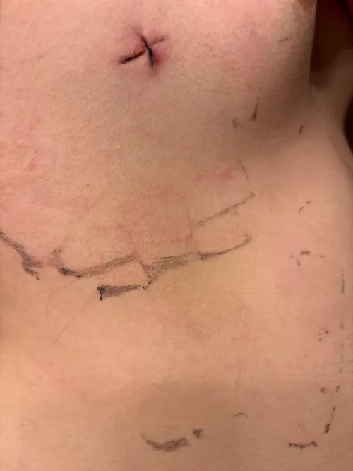 Is this infected context i had an suture on my chest last monday and wanted an opinion (20 male)