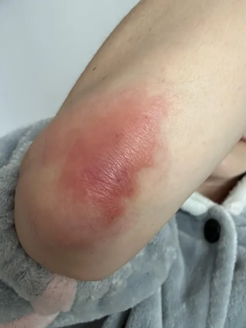 This happens to ONLY my elbow a couple of times a year. Several doctors, no diagnosis.