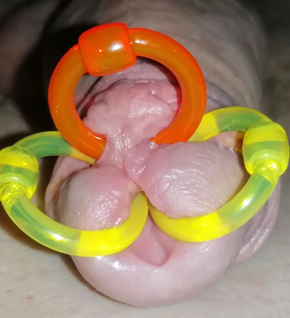 Meatotomy with double PA